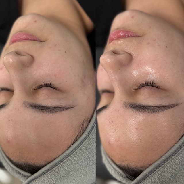 Chemical peel package of 3 at PERMALounge in Mooresville, NC