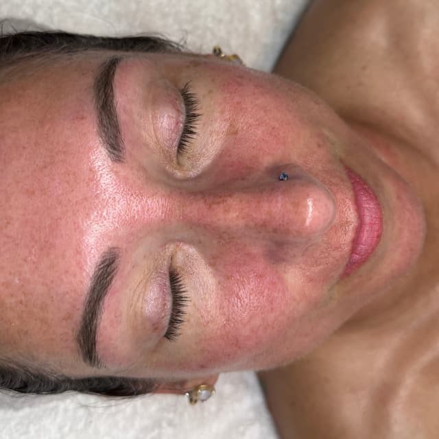 Chemical peel package of 6 at PERMALounge in Mooresville, NC